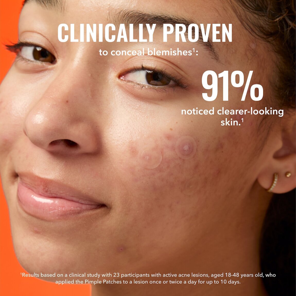 pimple-patches-n7 zb_p.jpg