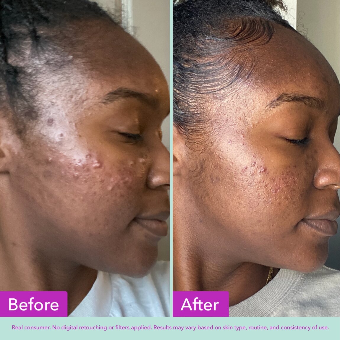 acne-foaming-cleanser-d3 zb_p.jpg